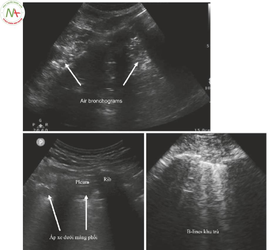 Hình 4 Kết quả siêu âm điển hình trong đông đặc và viêm phổi. Một loạt hình ảnh ở bệnh nhân viêm phổi đông đặc.