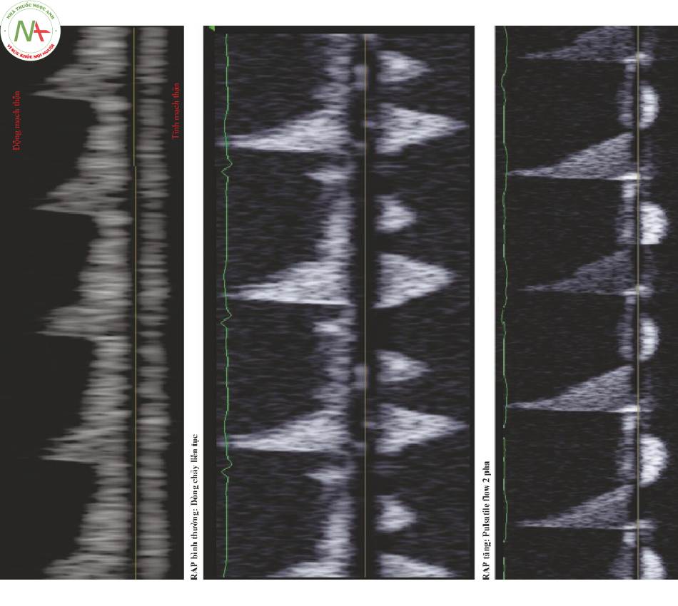 Hình 4 Lưu lượng tĩnh mạch thận thay đổi với sự gia tăng trong áplực nhĩ phải. Động mạch thận nằm trên đường cơ sở với Doppler xung trong cả ba hình. Hình phía trên: Dòng chảy tĩnh mạch bình thường; liên tục trong suốt thì tâm thu và tâm trương. Hình giữa: RAP tăng, dòng chảy tĩnh mạch đã trở thành Pulsatile. Hình dưới: RAP cao, chỉ có dòng chảy tâm trương đơn pha. Không có dòng chảy tĩnh mạch tâm thu.