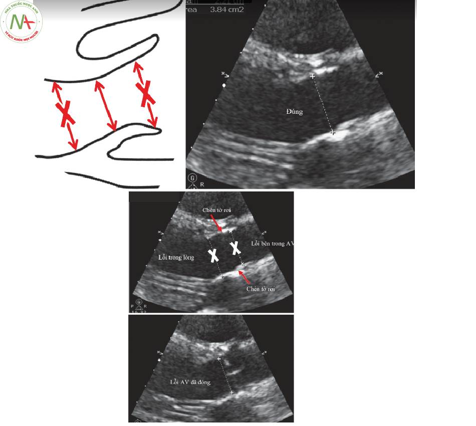 Hình 4 Những lôi trong LVOTD: Hình phía trên hiển thị phép đo chính xác; ngay bên trong AV mở. Hình giữa cho thấy LVOT được đo quá xa bên trong tim và quá xa trong van động mạch chủ. Hình dưới cùng hiển thị phép đo không chính xác với AV đóng