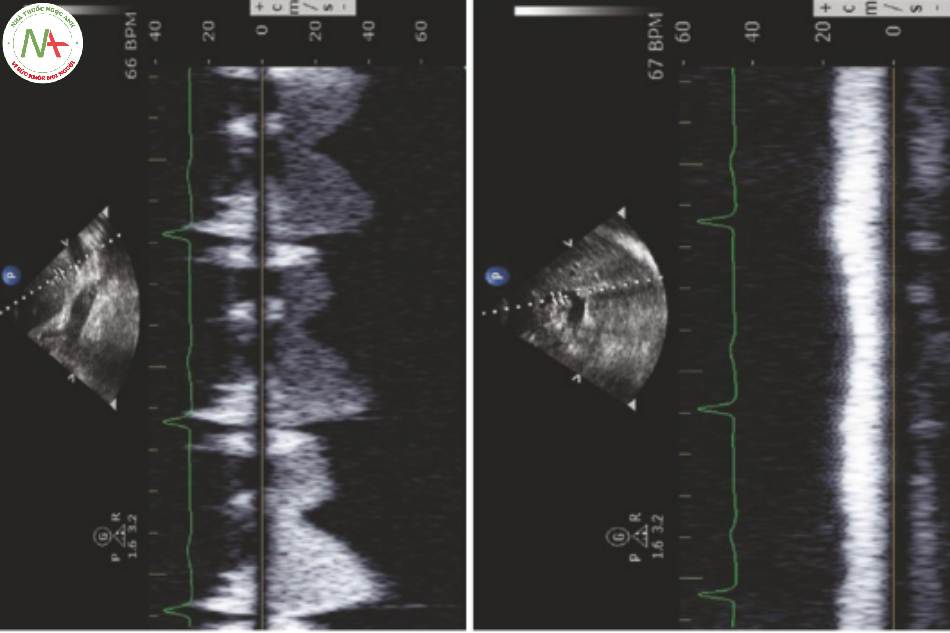Hình 4 Sóng xung gan và tĩnh mạch cửa bình thường Doppler. Bảngtrên, dòng tĩnh mạch gan bình thường. Bảng điều khiển phía dưới, lưu lượng tĩnh mạch cửa bình thường