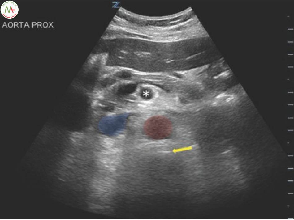 Hình 5 Hình ảnh này cho thấy một ví dụ về mặt cắt xem động mạch chủ bụng. Màu xanh là IVC, màu đỏ là động mạch chủ. Ngôi sao là động mạch mạc treo tràng trên. Mũi tên chỉ vào đường đốt sống