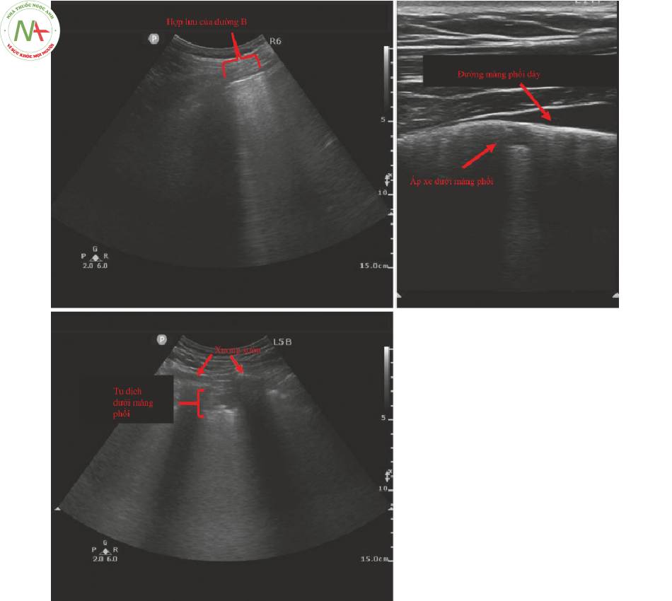 Hình 6 Dấu hiệu siêu âm phổi trong COVID-19. Phía trên bên trái_ Hợp lưu của các đường