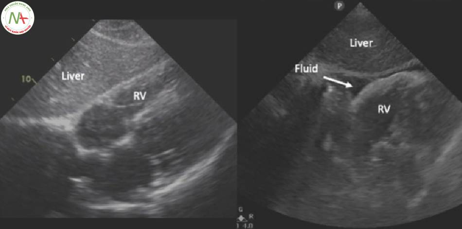 Hình 6 FAST mặt cắt dưới sườn. Hình bên trái âm tính với dịch màng ngoài tim. Hình bên phải dương tính với dịch màng ngoài tim. (RV_ Tâm thất phải)