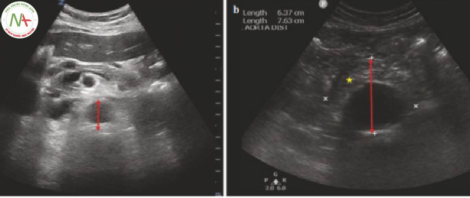 Hình 6 Hình ảnh này cho thấy một ví dụ về phình động mạch chủ bụng (b) so với động mạch chủ bình thường (a) và cách đo đúng. Ngôi sao màu vàng là xơ vữa động mạch trong lòng động mạch chủ. (Hình ảnh B được cung cấp bởi khoa cấp cứu Đại học Maryland)