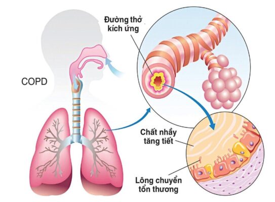 COPD: Hướng dẫn điều trị 2023