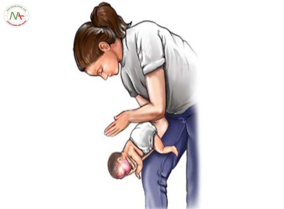Hóc nghẹn ở trẻ sơ sinh và trẻ nhỏ - Nghiệm pháp Heimlich