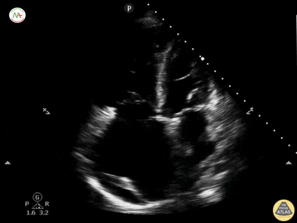 Giãn thất phải (RV) trên mặt cắt 4 buồng ở mỏm tim