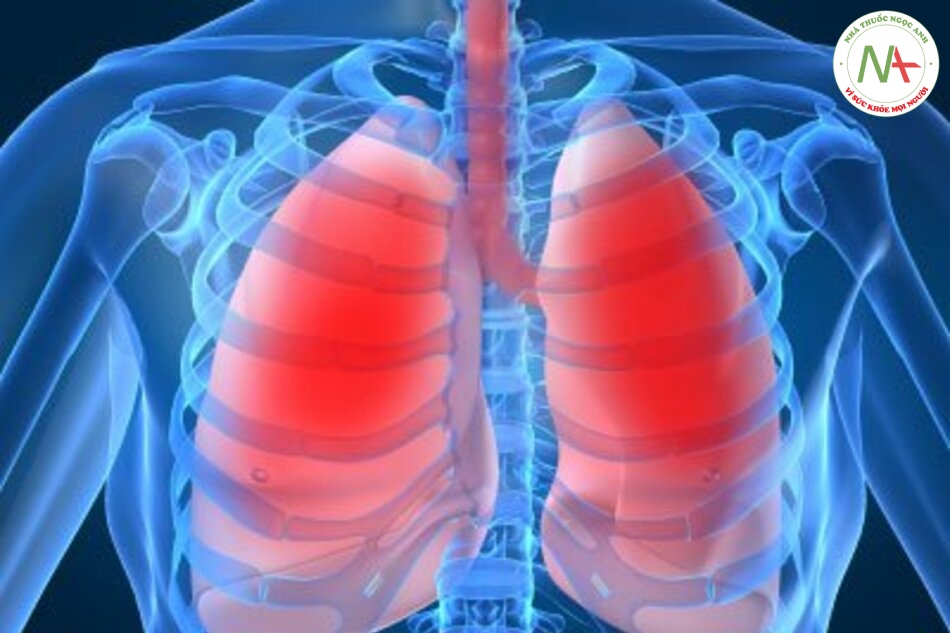Áp lực đẩy để thông khí cho bệnh nhân mắc hội chứng nguy kịch hô hấp cấp tính