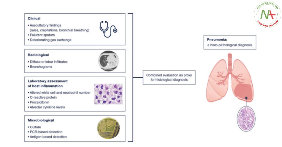 Biểu diễn đồ họa của đánh giá kết hợp đánh giá lâm sàng, X quang và xét nghiệm về phản ứng của vật chủ và dữ liệu vi sinh để chẩn đoán viêm phổi như một đại diện cho kiểm tra mô bệnh học
