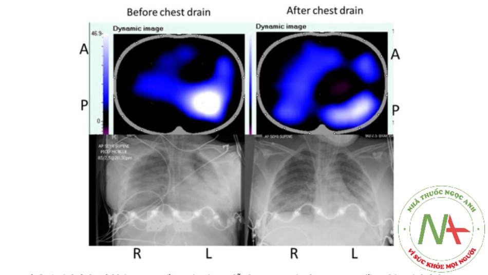  Hình 5 Hình ảnh trở kháng trực tiếp trước và sau dẫn lưu ngực, với phim X quang đồng thời. Hình ảnh EIT trực tiếp cho thấy sự thay đổi trở kháng ở từng khu vực, với các pixel sáng hơn (trắng hơn) biểu thị sự thay đổi trở kháng lớn hơn, tương đương với việc tăng thông khí, ở khu vực đó.