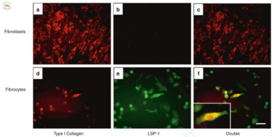 Hình 3.7 Nhuộm miễn dịch tế bào sợi. Nguyên bào sợi biểu hiện nhuộm collagen loại 1 (a), tuy nhiênkhông tìm thấy protein-1 đặc hiệu bạch cầu (LSP-1) (b). Phương pháp nhuộm miễn dịch kép khẳng định rằng nguyên bào sợi chỉ biểu hiện collagen loại I (c). Mặt khác, các tế bào sợi biểu hiện cả collagen loại I (d), LSP-1 (e), và miễn dịch huỳnh quang kép đã xác định sự hiện diện của cả hai protein (f) [55].
