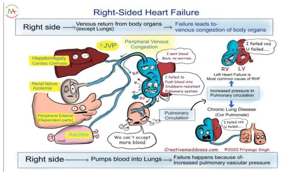 Right-sided Heart Failure 