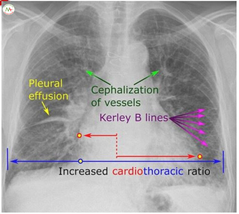 Dấu hiệu tim to và đánh giá tình trạng sung huyết phổi