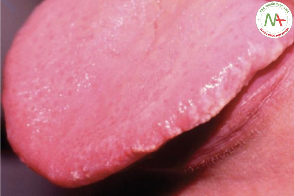 Bạch sản lông ở miệng liên quan đến AIDS