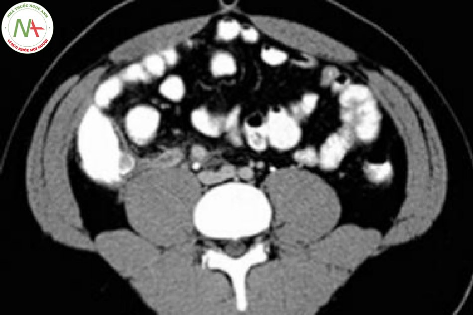 CT scan cho thấy ruột thừa lớn có thành dày, không chứa chất cản quang đại tràng, nằm liền kề cơ psoas phải.