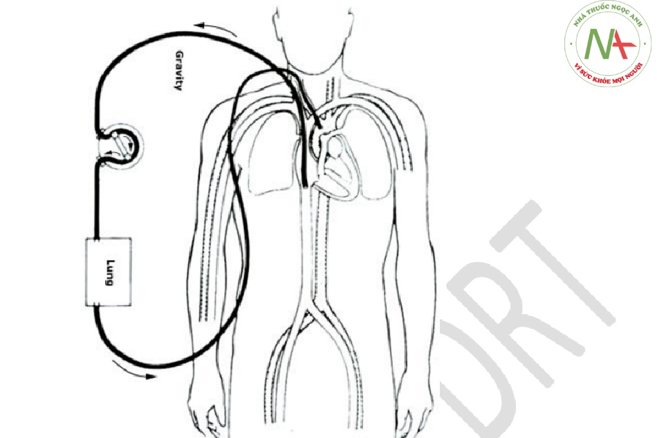 ECMO tĩnh mạch (VA) cho suy tim và/hoặc suy hô hấp