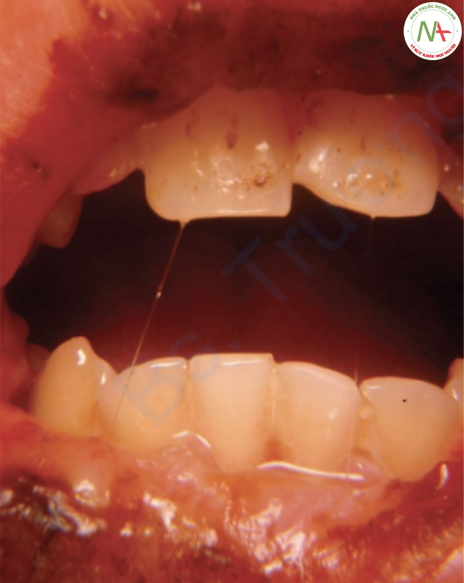 Herpetic gingivostomatitis – nhiều vết trợt gây đau trên niêm mạc môi và nướu bị viêm