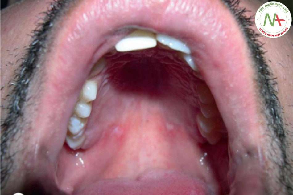 Hội chứng Behçet - Loét miệng trên vòm họng cứng