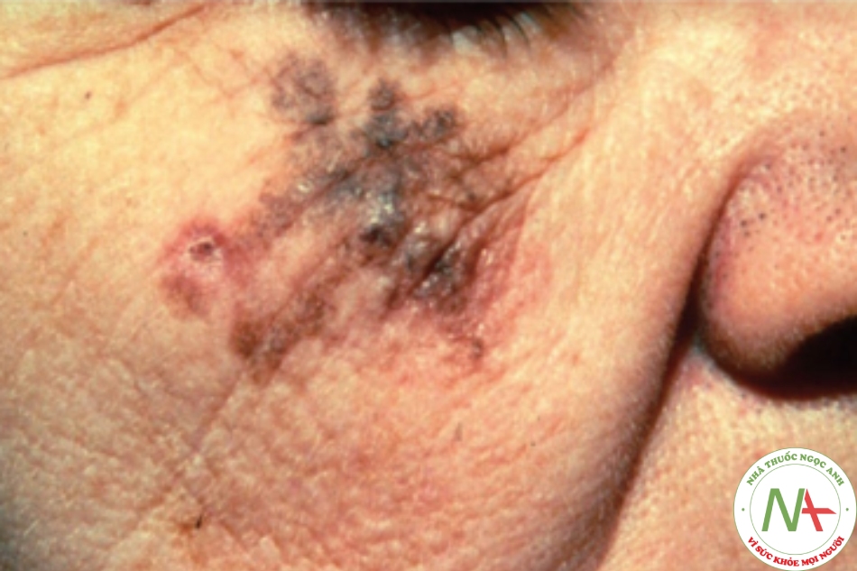 Lentigo maligna melanoma – dát lớn, nâu, đen, hình dạng không đều thường xuất hiện trên mặt người cao tuổi