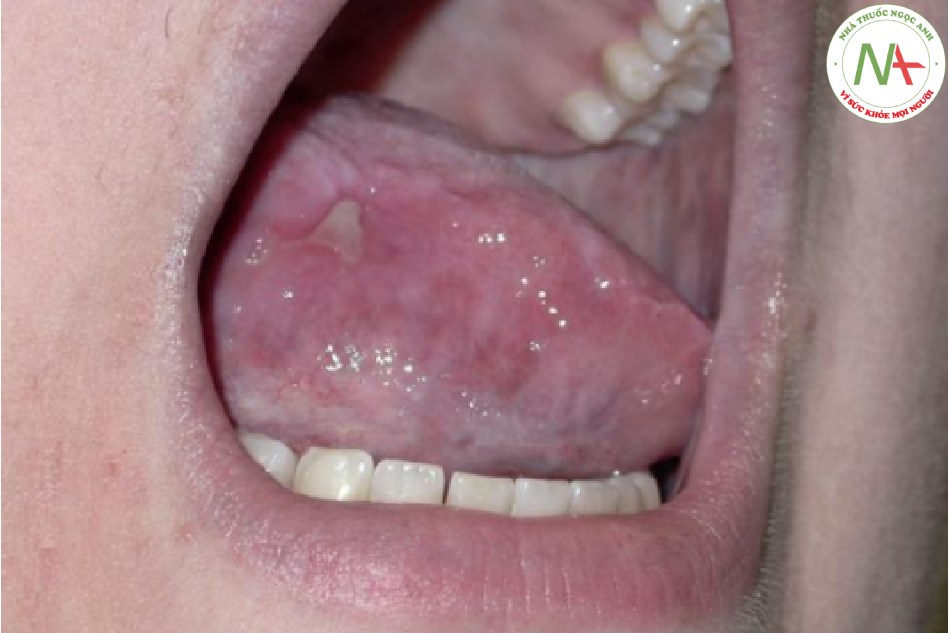Lichen phẳng – vết loét trên lưỡi phải được sinh thiết để loại trừ ung thư biểu mô tế bào vảy