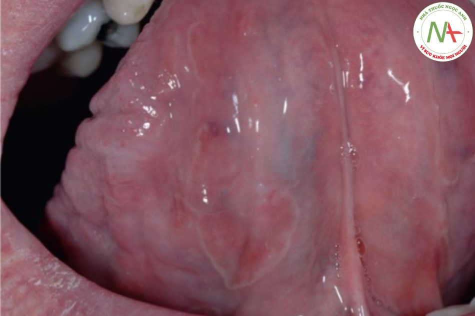 Lưỡi bản đồ – dát đỏ có viền trắng, hình vỏ sò ở mặt dưới lưỡi ở bệnh nhân vảy nến
