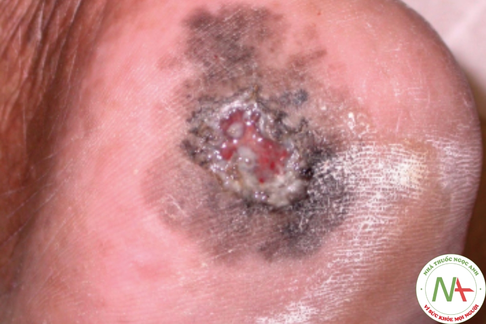 U hắc tố lentigo đầu chi ở lòng bàn chân – mảng màu đen, nâu và trắng, có hình dạng không đều và bờ bị loét