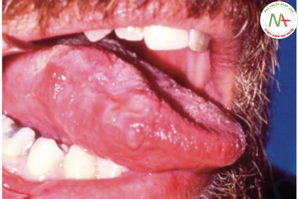 Ung thư biểu mô tế bào vảy ở lưỡi – bề mặt của nốt lớn này có màu trắng (tăng sừng hóa) và bị loét, phần gốc có cảm giác cứng và chai
