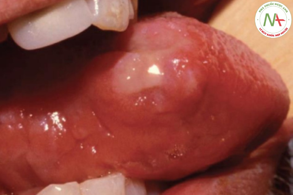 Ung thư biểu mô tế bào vảy – nốt cứng ở một bên lưỡi; sinh thiết là bắt buộc