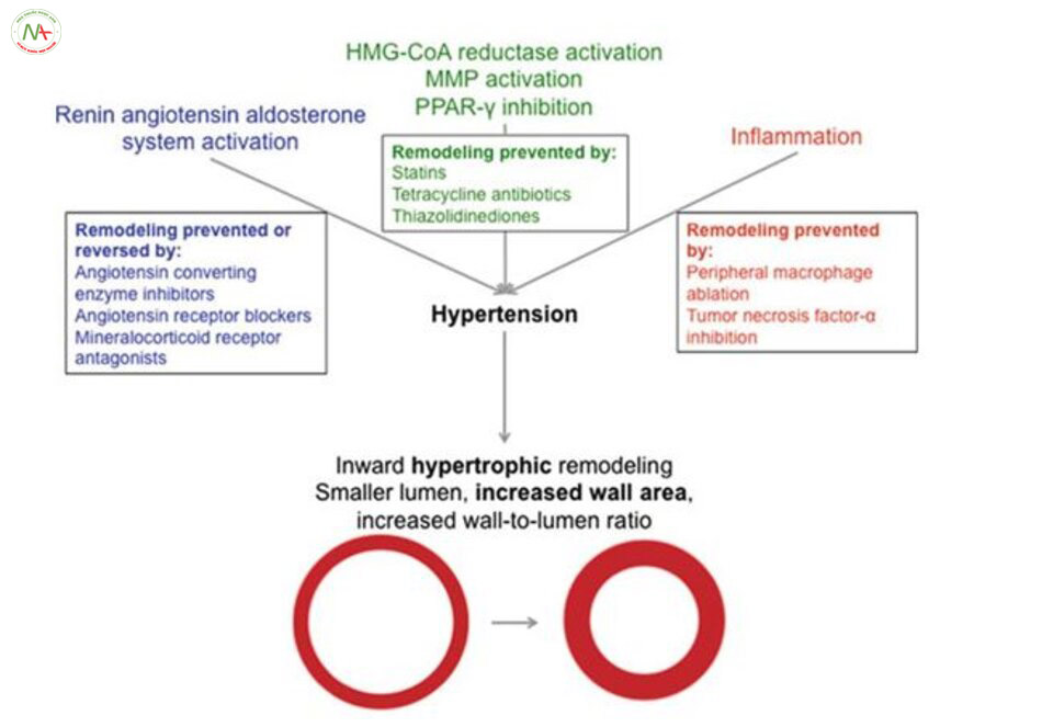 Fig. 5.4 Hypertensive artery remodeling. The figure depicts most commonly observed effects of hypertension on cerebral artery structure, a normotensive artery is shown on the left, and hyperten- sive artery undergoing hypertrophic inward remodeling is shown on the right. The text boxes describe some of the clinically relevant mechanisms to prevent or reverse cerebral artery remodeling
