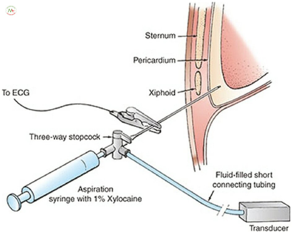 Hình ảnh cho thấy phương pháp tiếp cận dưới mũi ức để chọc dịch màng ngoài tim với cảm biến áp lực và theo dõi đoạn ST: Một cây kim 18 -gauge rỗng, thành mỏng được nối thông qua một khóa ba chiều với một bơm tiêm dùng để hút chứa Xylocaine 1% và với một đoạn ống ngắn chứa đầy dịch được nối với một bộ chuyển đổi áp lực. Một dây dẫn chuyển đạo V-5 vô trùng của máy ghi điện tâm đồ có thể được gắn vào trục kim kim loại. Kim được đưa vào cho đến khi dịch màng ngoài tim được hút ra hoặc tổn thương xuất hiện trên bản ghi điện tâm đồ chuyển đạo V-5. Một khi dịch được hút ra, khóa 3 chiều được xoay để áp lực đầu kim được hiển thị so với áp suất tâm nhĩ phải được đo đồng thời từ catheter tim phải. Khi vị trí đầu kim trong khoang màng ngoài tim được xác nhận, dây dẫn(Guidewire) có đầu chữ J được luồn qua kim vào khoang màng ngoài tim, kim được rút ra và một catheter có lỗ ở đầu và lỗ bên được luồn qua dây dẫn và theo sau được nối qua khóa 3 chiều cho cả cảm biến áp lực và bơm tiêm. Điều này cho phép, đầu tiên, dẫn lưu triệt để tràn dịch màng ngoài tim bằng cách sử dụng catheter thay vì kim nhọn và, thứ hai, ghi nhận cho thấy sinh lý chèn ép tim giảm bớt khi áp lực nhĩ phải giảm và áp lực trong màng ngoài tim được khôi phục về mức bằng hoặc dưới 0.