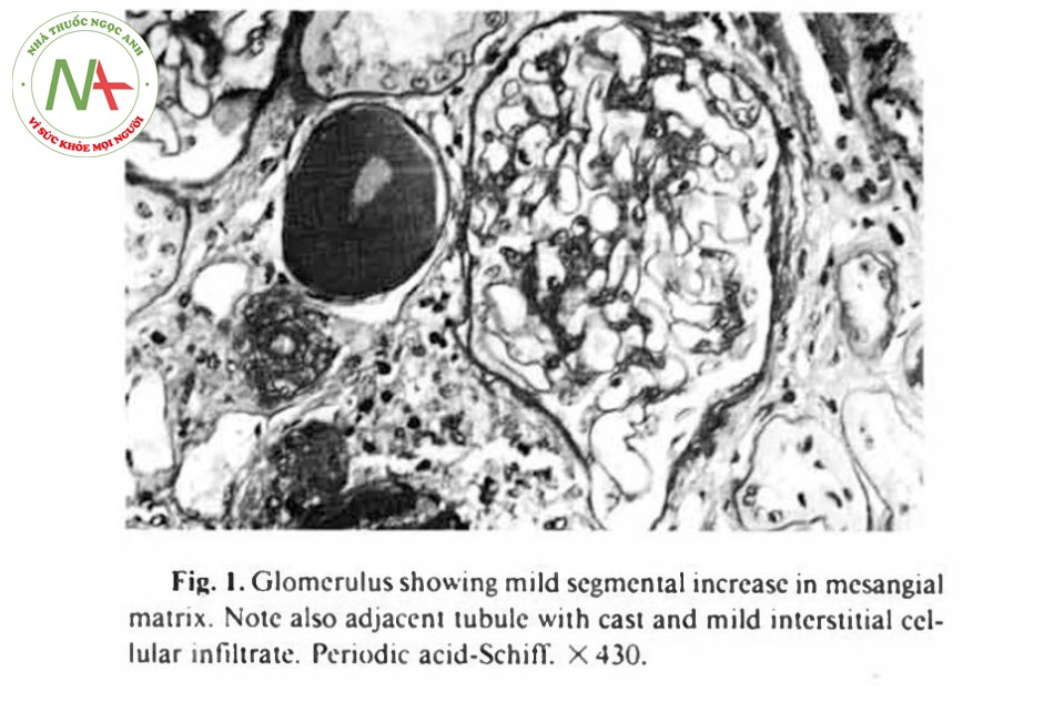 Hình 1. Cầu thận có các chất ở tế bào cạnh mao mạch cầu thận gia tang. Có các trụ lẫn thâm nhiễm nhẹ gian tế bào.