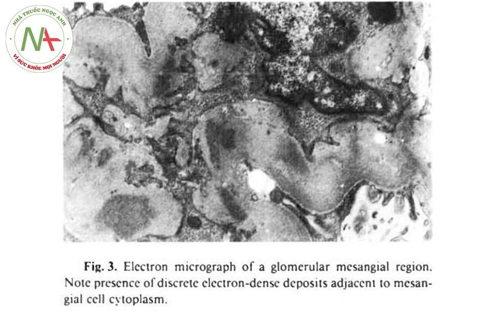 Hình 3. Hình ảnh điện tử cho thấy các vùng cạnh mao mạch cầu thận. Lưu ý có sự hiện diện của phwucs hợp lắng đọng ở tế bào chất của các tế bào cạnh mao mạch cầu thận.