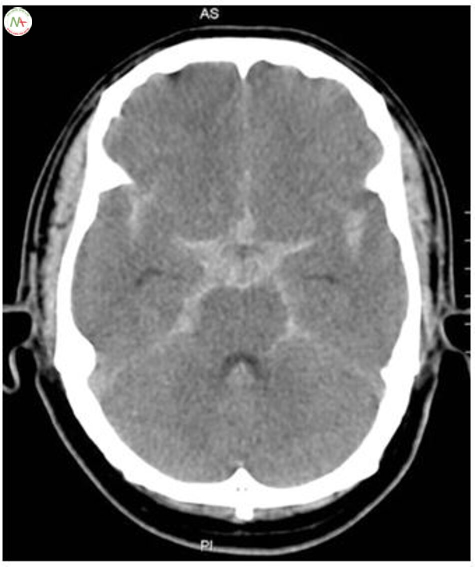 Fig. 6.6 Subarachnoid hemorrhage. Extensive blood clots occupy basal and perimesencephalic cisterns and both sylvian fissures