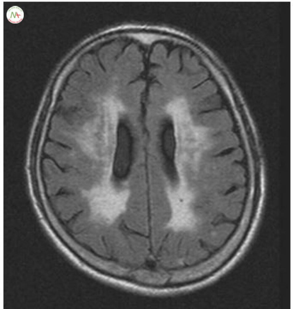 Fig. 6.7 White matter lesions. Extensive white matter changes (leukoaraiosis) are observed in both periventricular and subcortical white matter