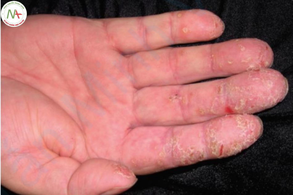 Bệnh vảy nến – dát đỏ, có vảy trên tay, thường liên quan đến móng tay
