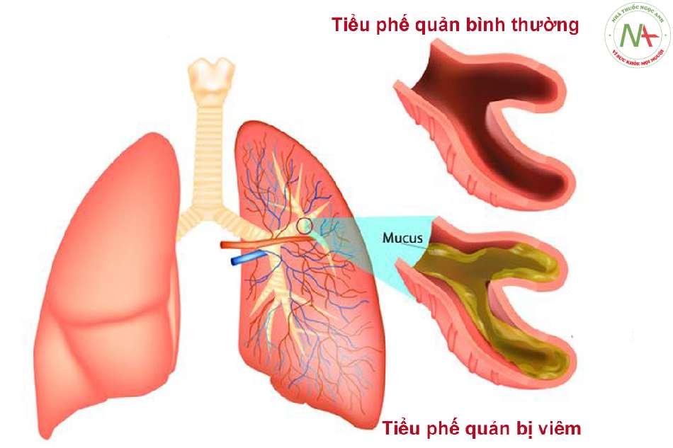 Cơ học hô hấp ở trẻ viêm tiểu phế quản nặng thở máy có kiểm soát