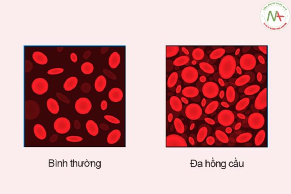 Đa hồng cầu ở trẻ sơ sinh