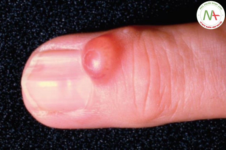 HÌNH 20 Nang myxoid – nốt trắng đục của nếp gấp móng tay tạo ra một đường rãnh đặc trưng trên phiến móng tay