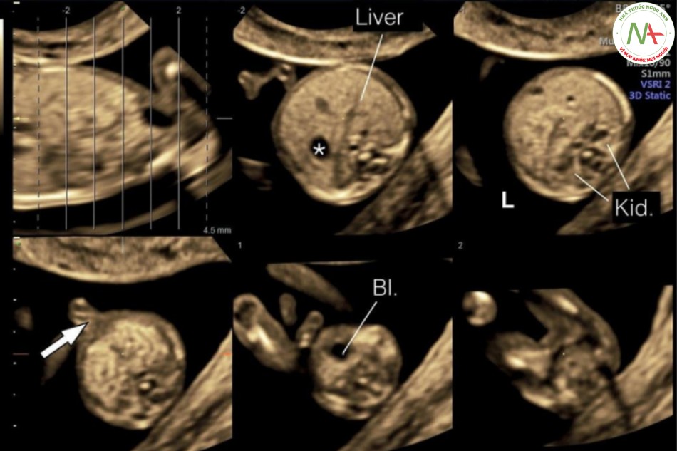 Hình 10: Mặt cắt ngang bụng với chế độ cắt lớp ở thai nhi 12 tuần tuổi cho thấy bụng trên, bụng giữa và bụng dưới