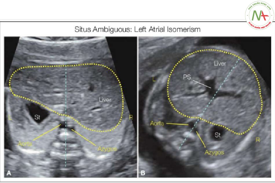 Hình 13: Hình A và B cho thấy mặt cắt ngang bụng ở hai thai nhi có situs mơ hồ, với đồng dạng nhĩ trái