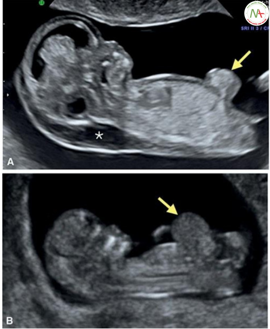 Hình 13: Mặt cắt dọc giữa ở hai thai nhi có thoát vị rốn (mũi tên) nhỏ (A) và lớn (B) ở 12 tuần tuổi