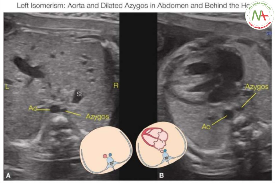 Hình 15: Mặt cắt ngang bụng (A) và ngực (B), cùng với hình vẽ giản đồ tương ứng, ở thai nhi 22 tuần tuổi có hội chứng đồng dạng bên trái