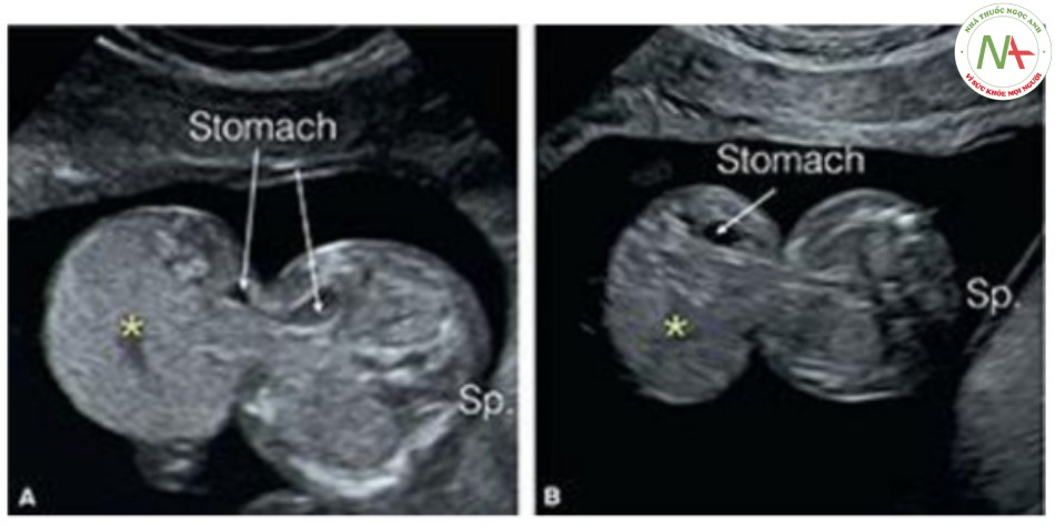 Hình 15: Mặt cắt ngang thành bụng ở mức dây rốn cắm vào ở hai thai nhi 12 (A) và 13 (B) tuần tuổi