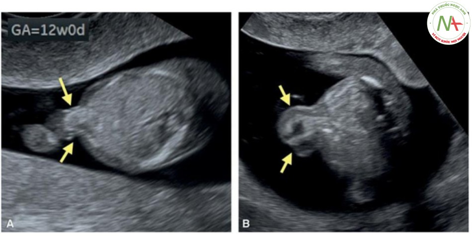 Hình 16: Mặt cắt ngang thành bụng ở mức dây rốn cắm vào ở hai thai nhi 12 (A) và 13 (B) tuần tuổ