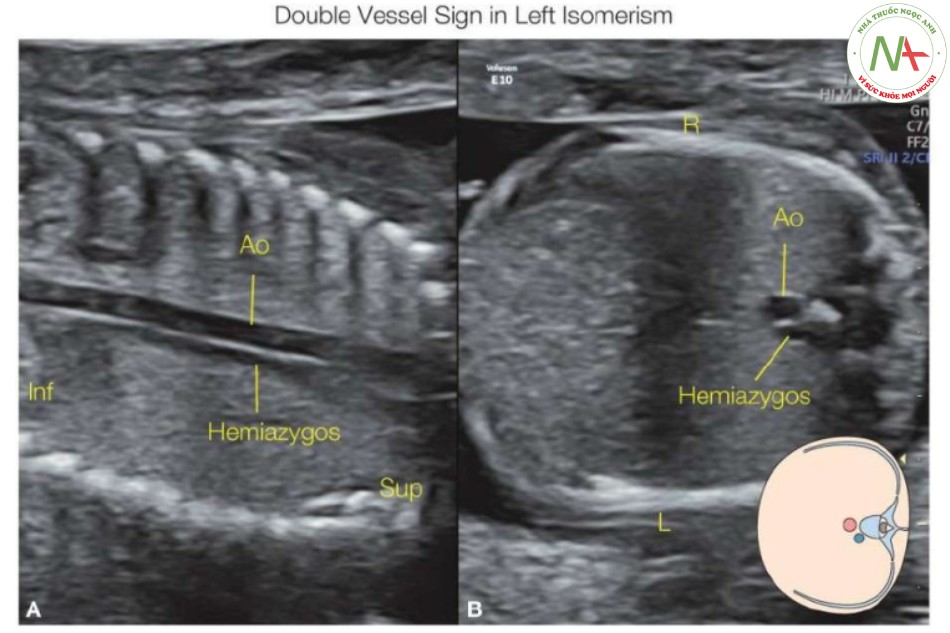 Hình 16: Mặt cắt vành (A) và ngang (B) ngực và bụng thai nhi có đồng dạng bên trái