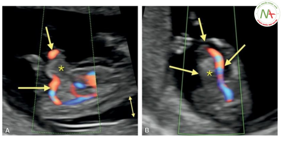 Hình 17: Mặt cắt dọc (A) và ngang (B) của bụng giữa trong Doppler màu ở thai nhi 12 tuần tuổi bị trisomy 18.