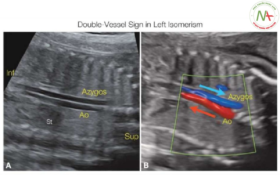 Hình 17: Mặt cắt vành (A, B) của ngực và bụng thai nhi có đồng dạng nhĩ trái