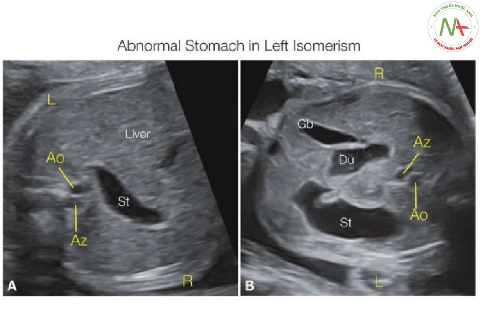 Hình 18: Mặt cắt ngang bụng trên ở hai thai nhi (A, B) với đồng dạng nhĩ trái.
