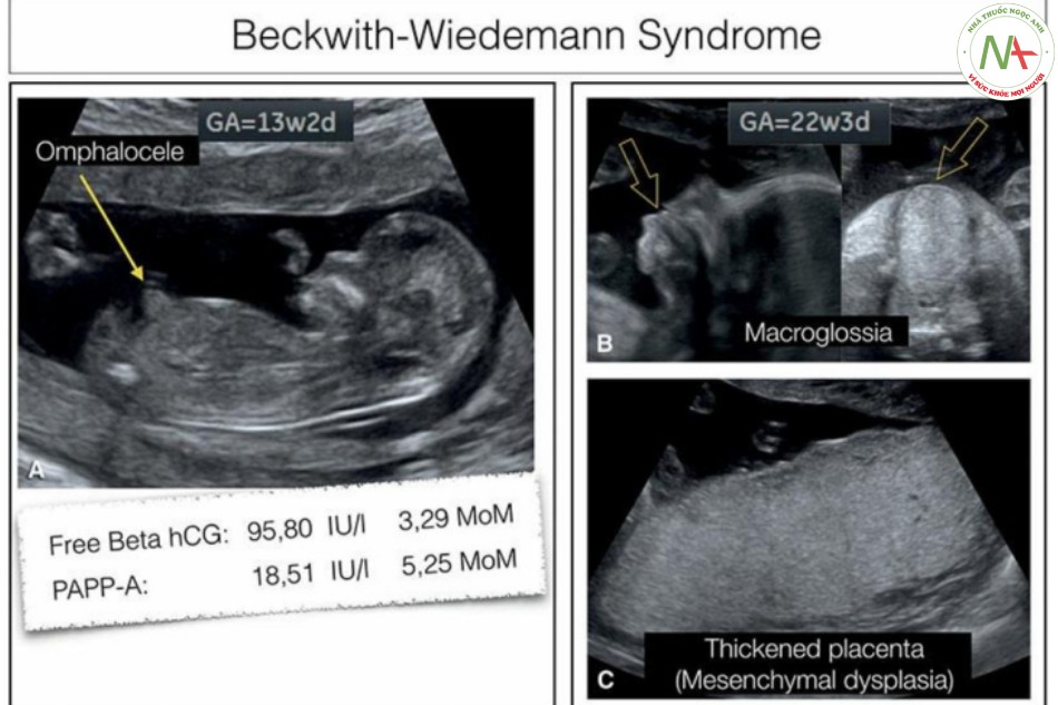 Hình 18: Thai nhi mắc hội chứng Beckwith – Wiedemann
