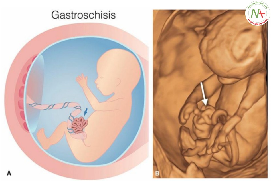 Hình 19: Hình vẽ giản đồ (A) và hình ảnh siêu âm 3D tương ứng ở chế độ bề mặt của một thai nhi 13 tuần tuổi bị hở thành bụng